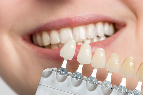 Philips Zoom Bleaching